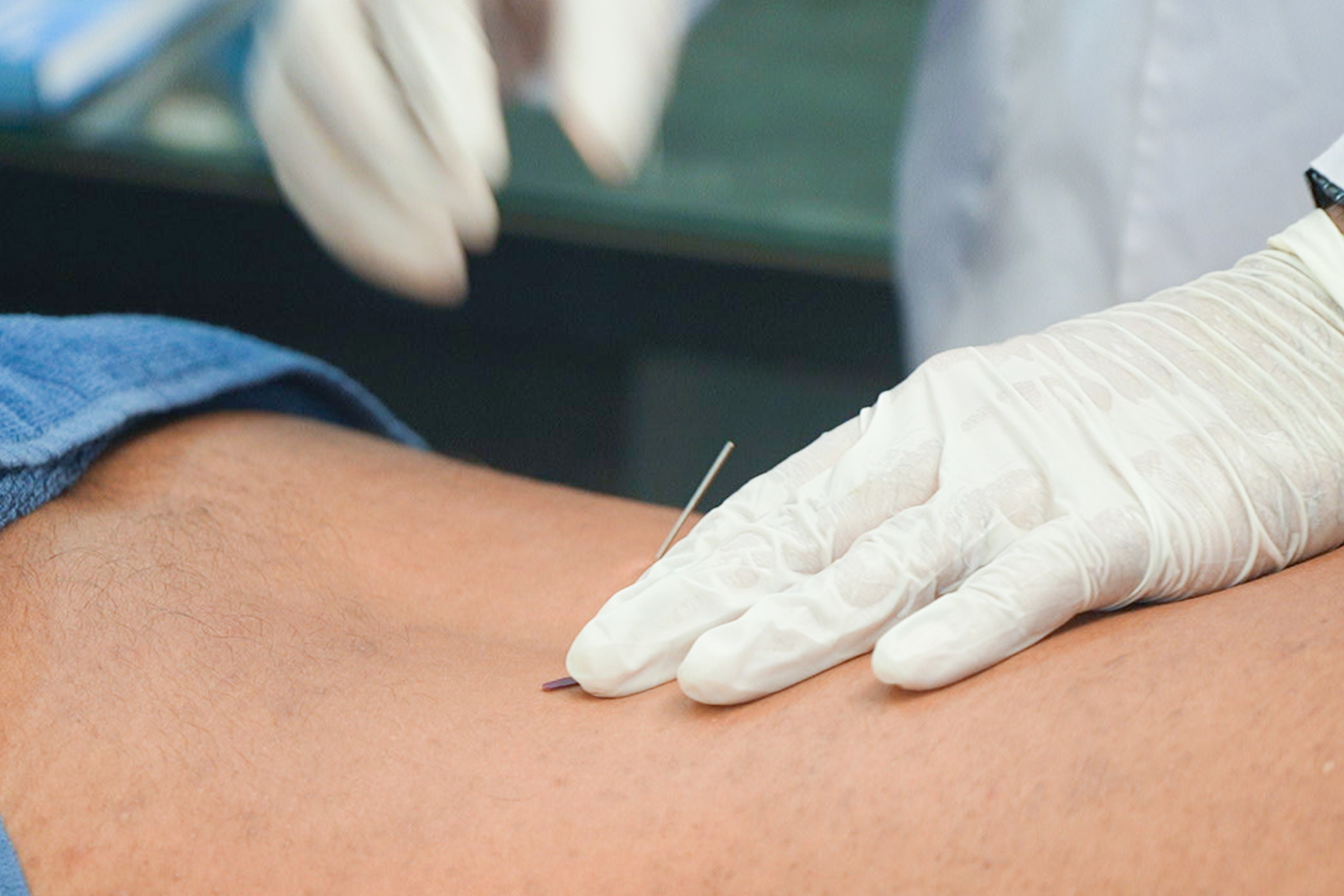 Dry Needling