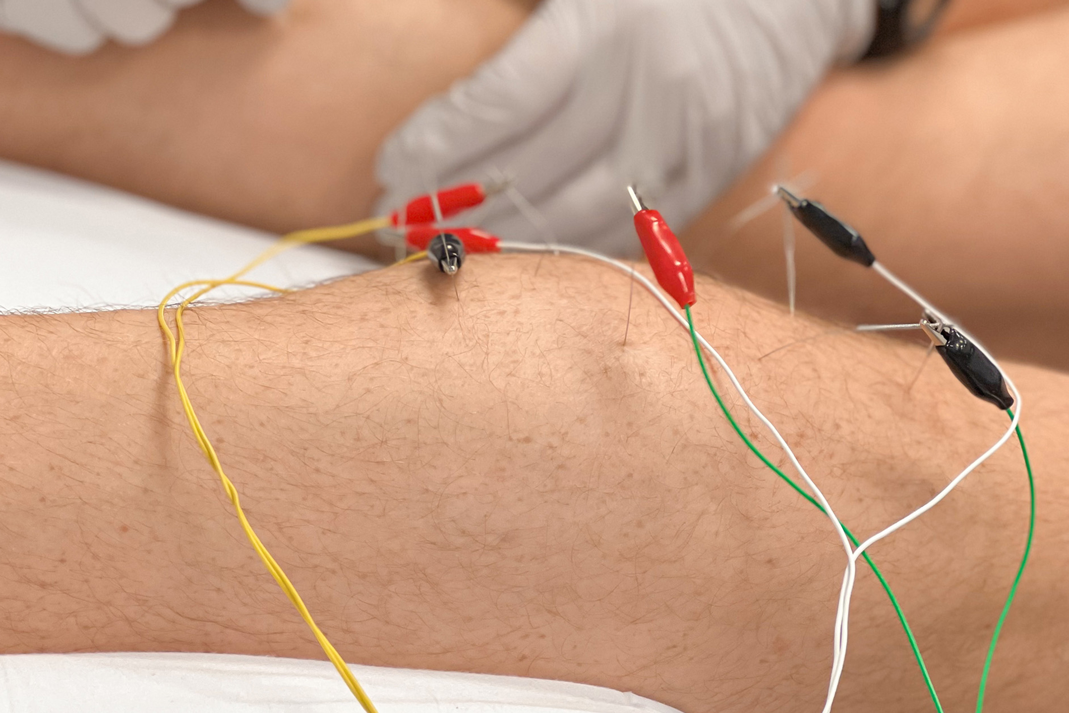 Dry Needling