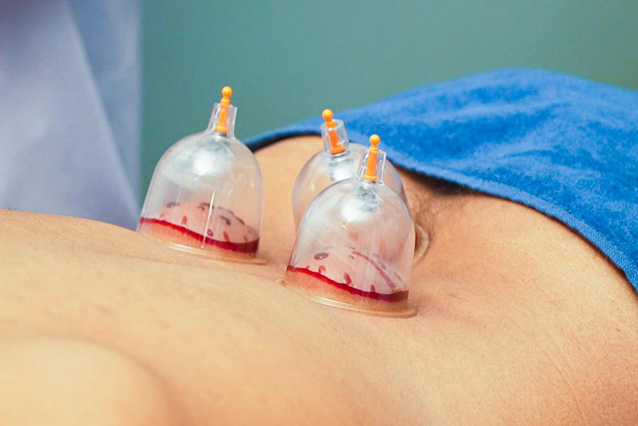 Hijama (Cupping Therapy)